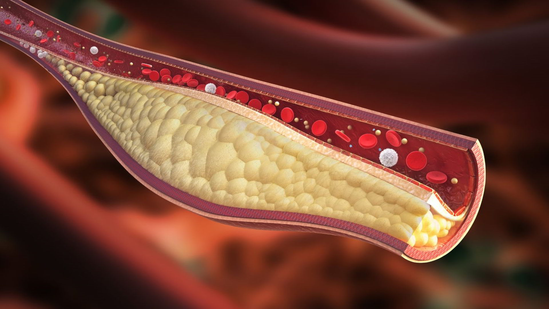 LDL cholesterol nahromadeny na stene cievy.